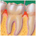 Zahnfleischentzündung (Gingivitis)